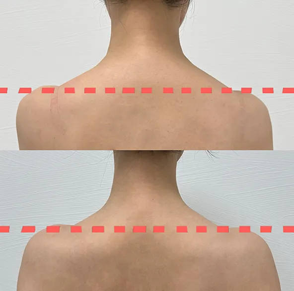エラボトックスでエラのハリが解消されています