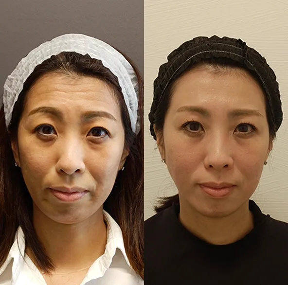 エラボトックスでエラのハリが解消されています