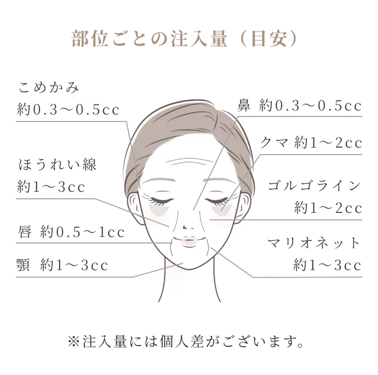 浅いシワの場合はヒアルロン酸を1本注入。深いシワの場合は2本注入。