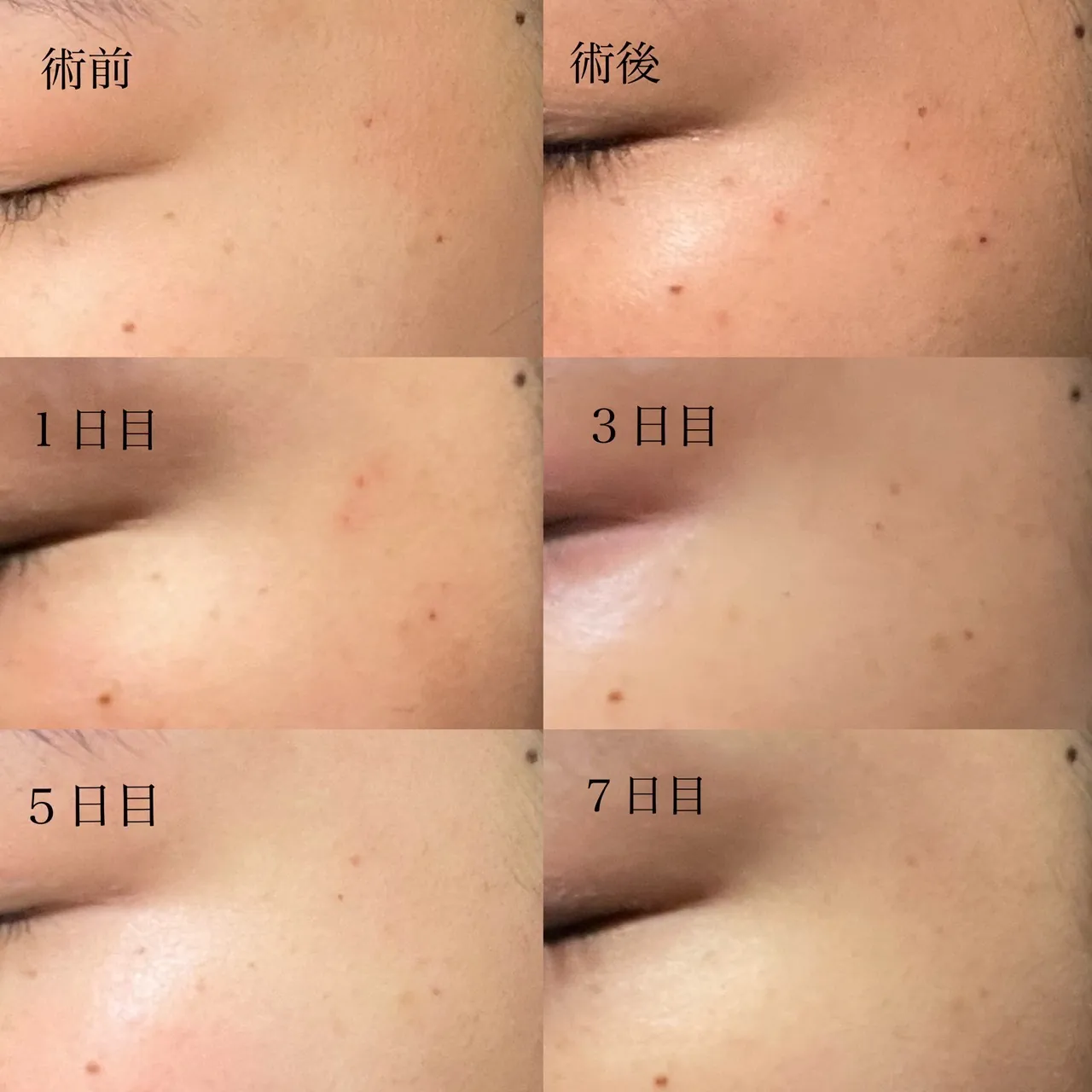 ルメッカで肌のハリが解消されています