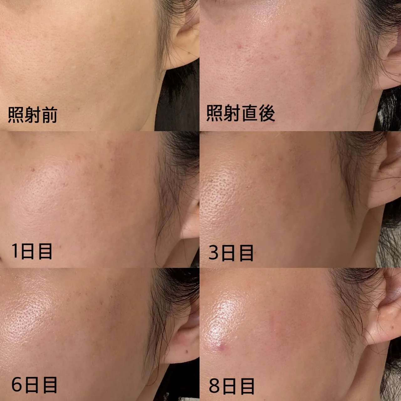 ルメッカで肌のハリが解消されています