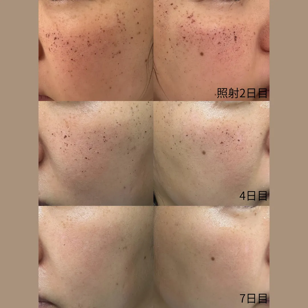 ルメッカで肌のハリが解消されています