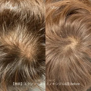 AGA治療