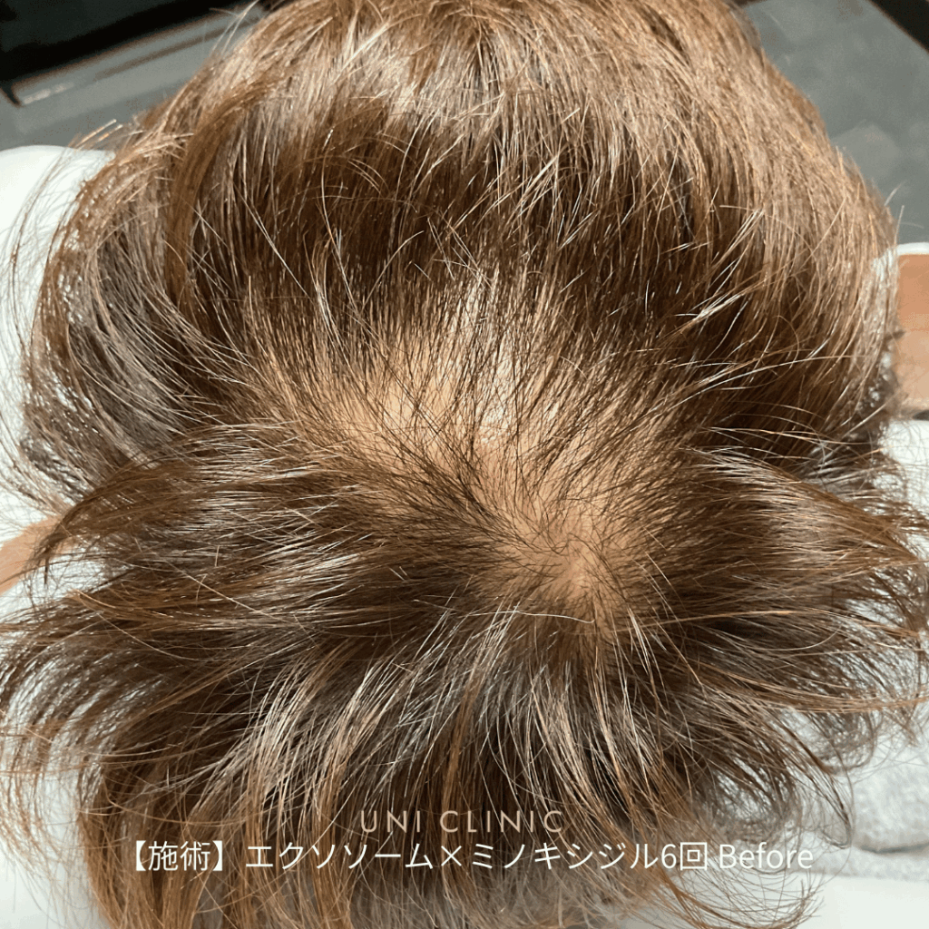 AGA治療