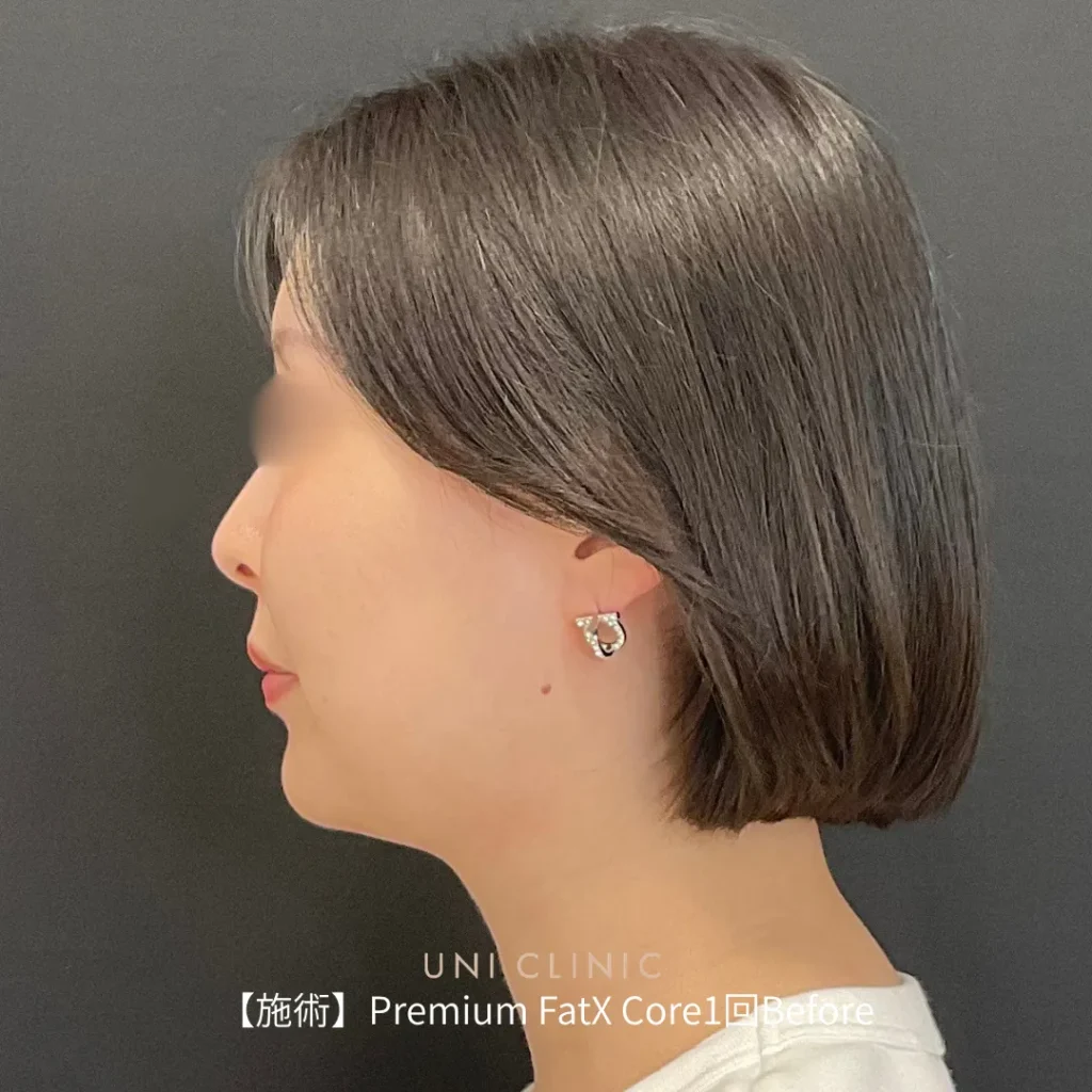脂肪溶解注射
