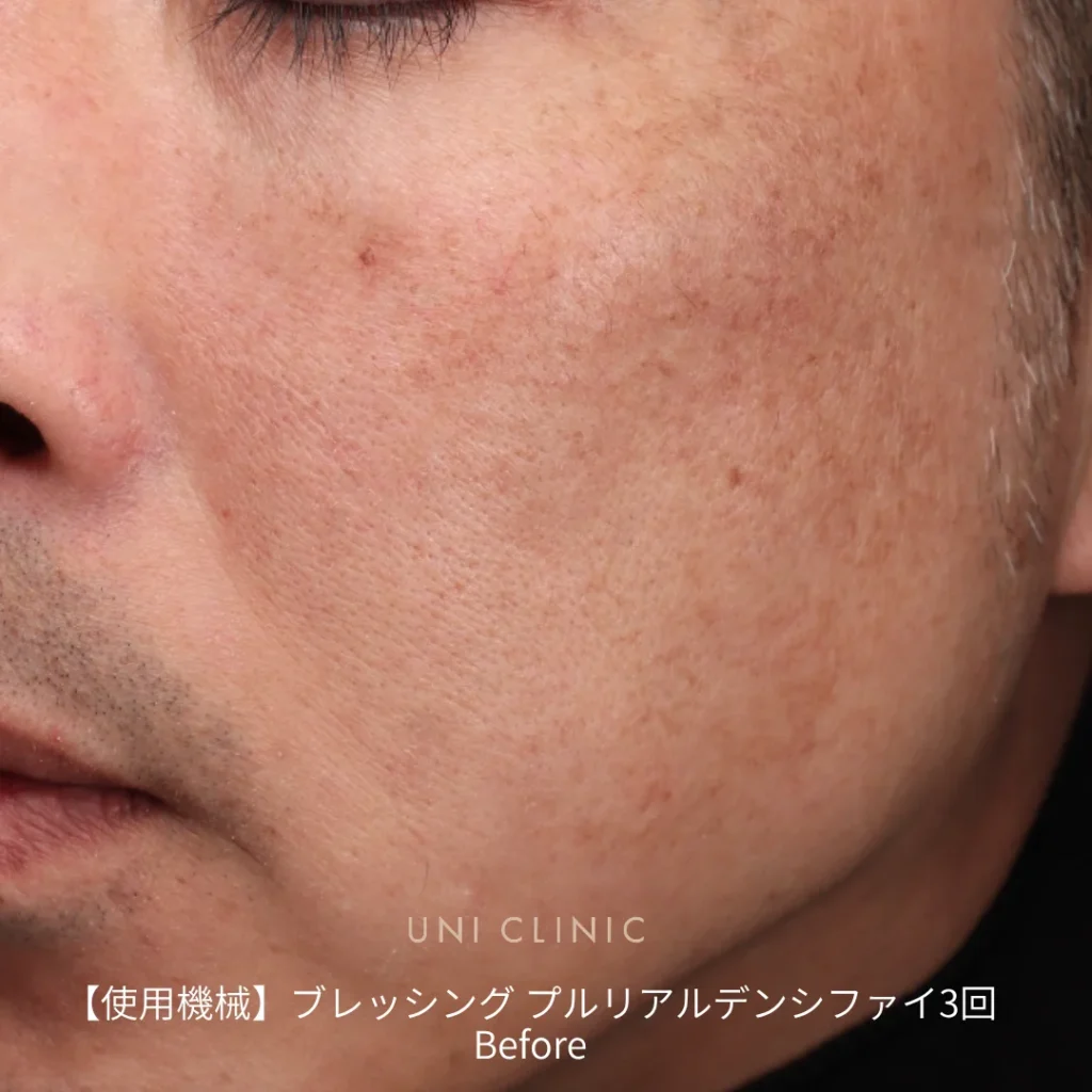 ブレッシング