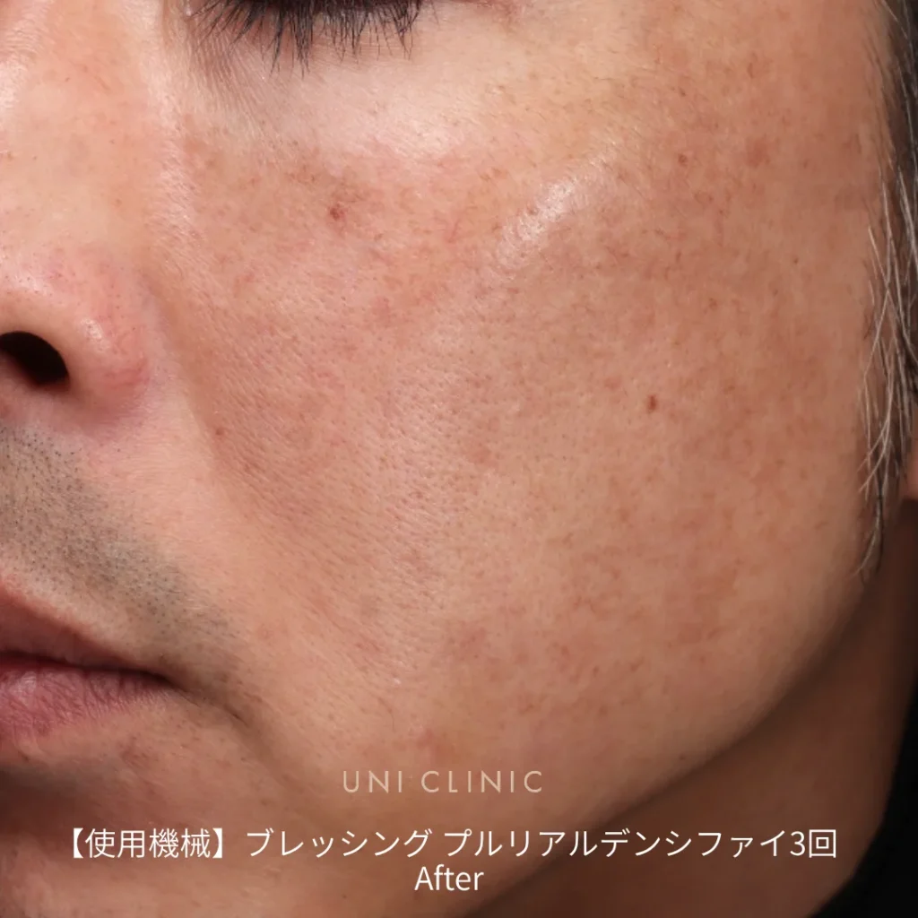 ブレッシング